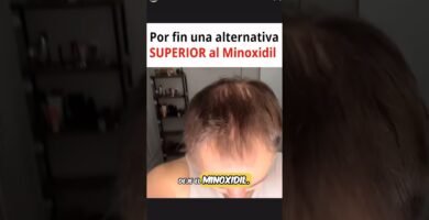Minoxidil natural: ¿existe una alternativa? efectividad comprobada