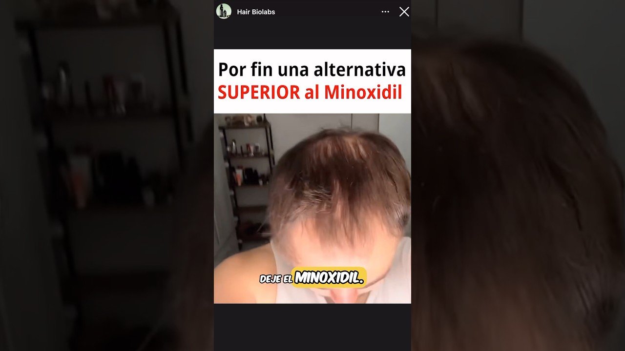 Minoxidil natural: ¿existe una alternativa? efectividad comprobada